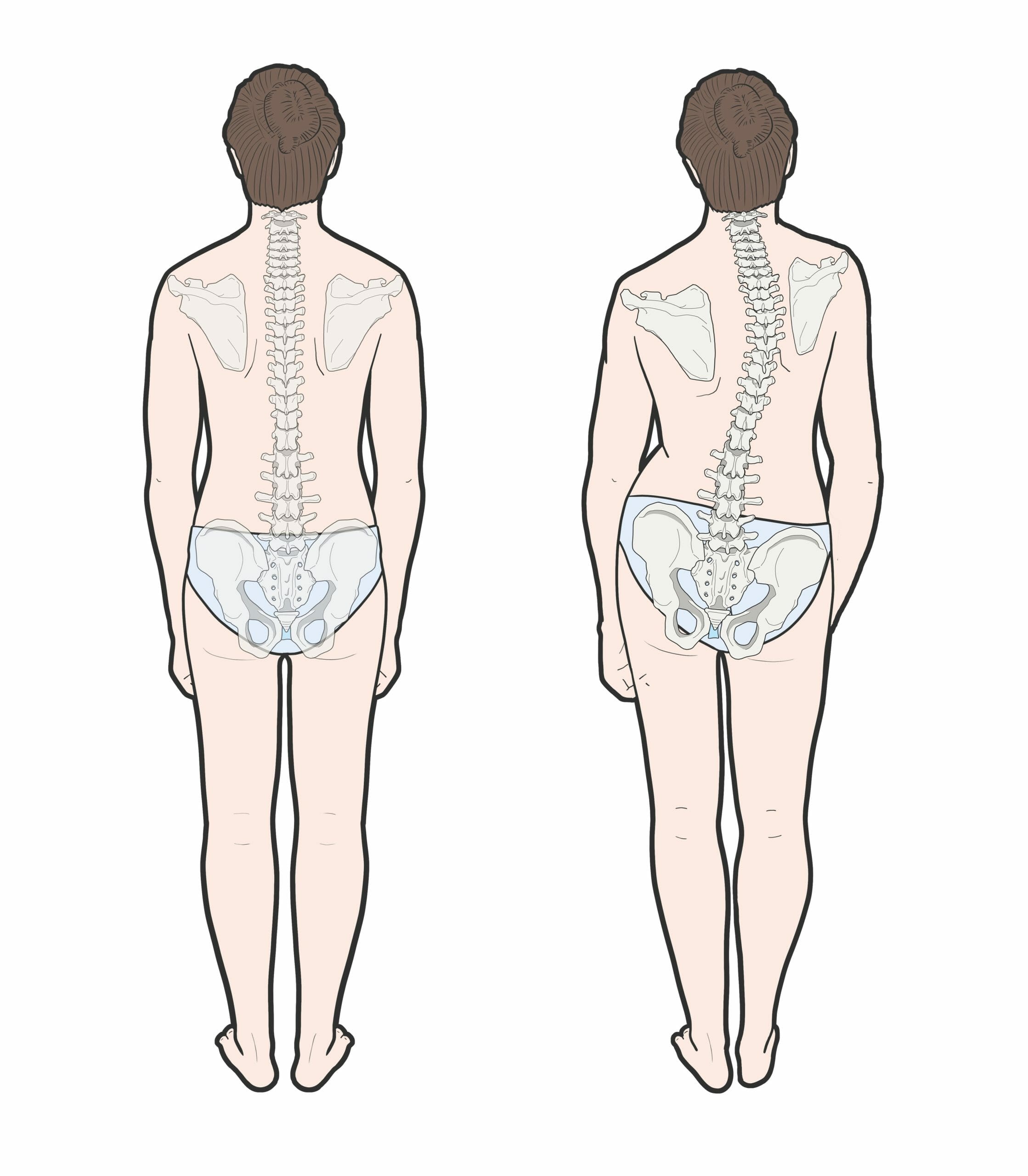 Scoliosis Second Image