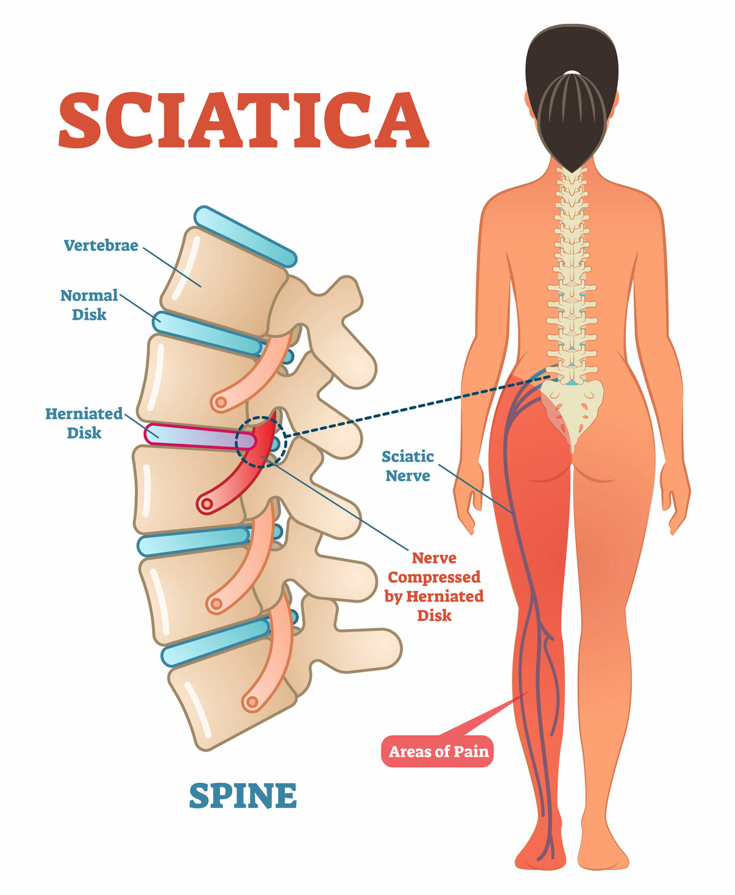 Infographic for lower back pain